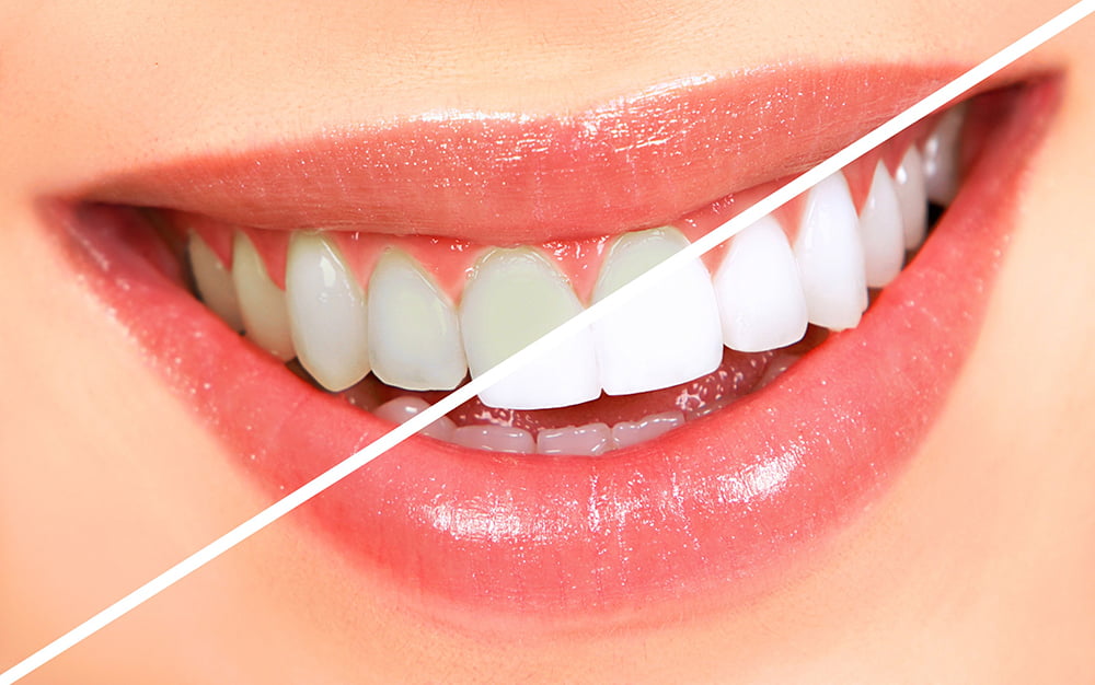 Whitening teeth 10 Facts