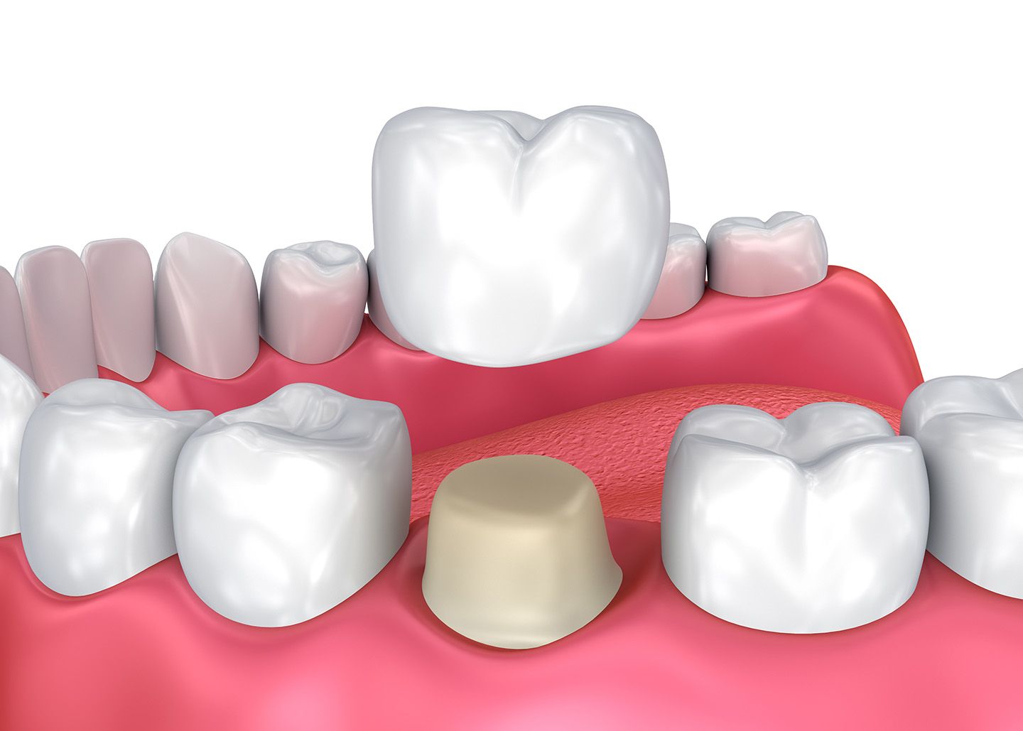 Prosthodontics - Absolute Dental ®