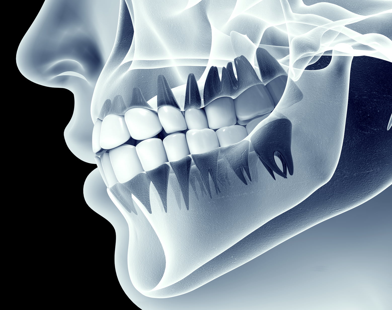 X Ray Of Teeth